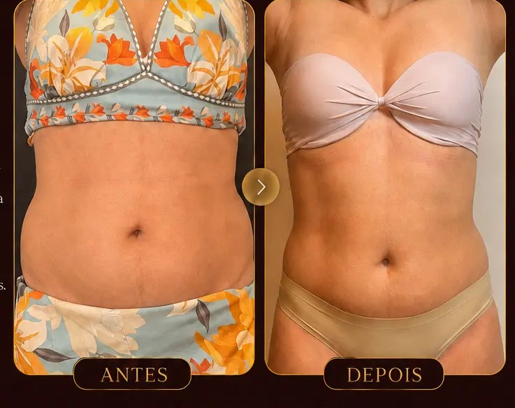 Antes e depois — Emagrecimento MetaSlim na Clínica Metamorphosis