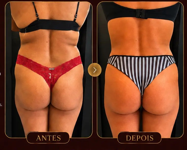 Antes e depois — Emagrecimento MetaSlim na Clínica Metamorphosis