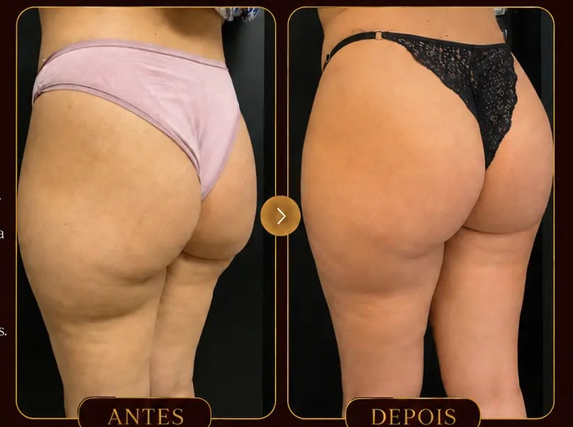 Antes e depois — Harmonização glútea na Clínica Metamorphosis