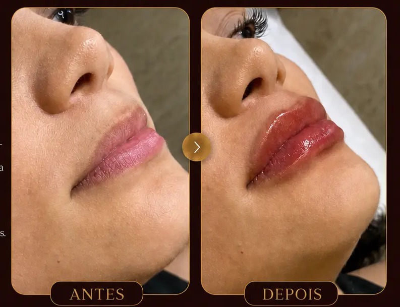 Antes e depois — Preenchimento labial na Clínica Metamorphosis