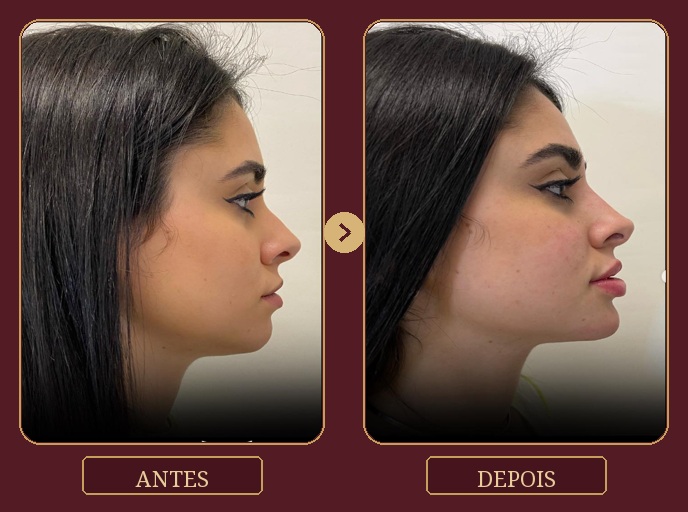 Antes e depois — Harmonização facial na Clínica Metamorphosis